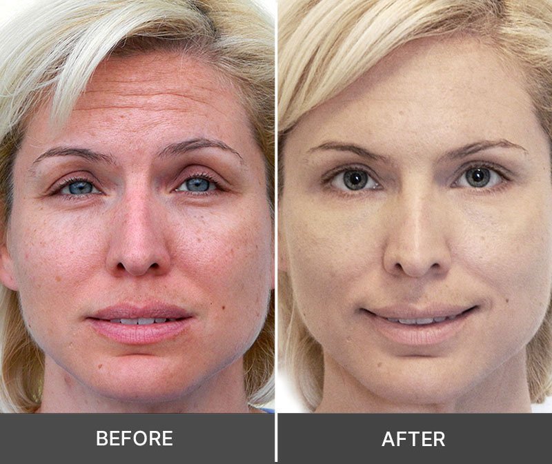 idrotherapy-before-after-results-mature-skin
